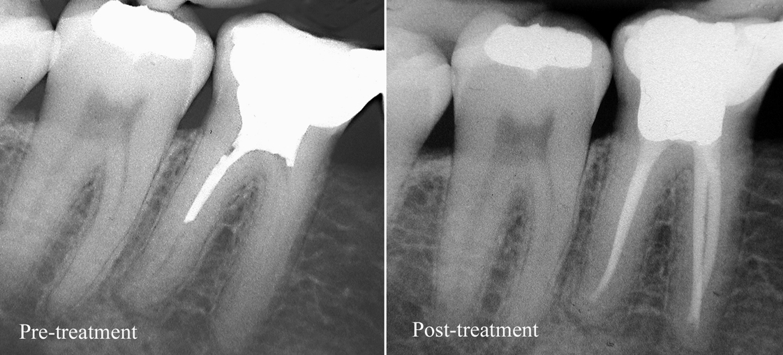 Dental instruments for clinical treatment